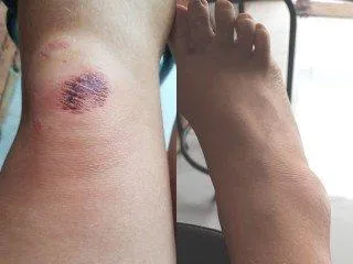 Knie und Kn&ouml;chel zwei Tage nach meinem Sturz